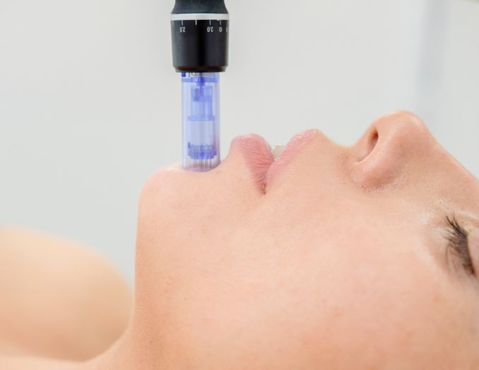 Mesoterapia con Dermapen